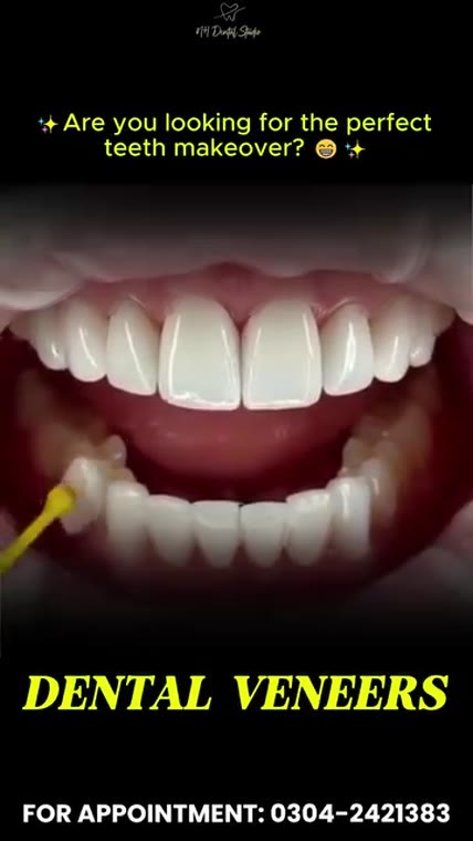 The Magic of Veneers