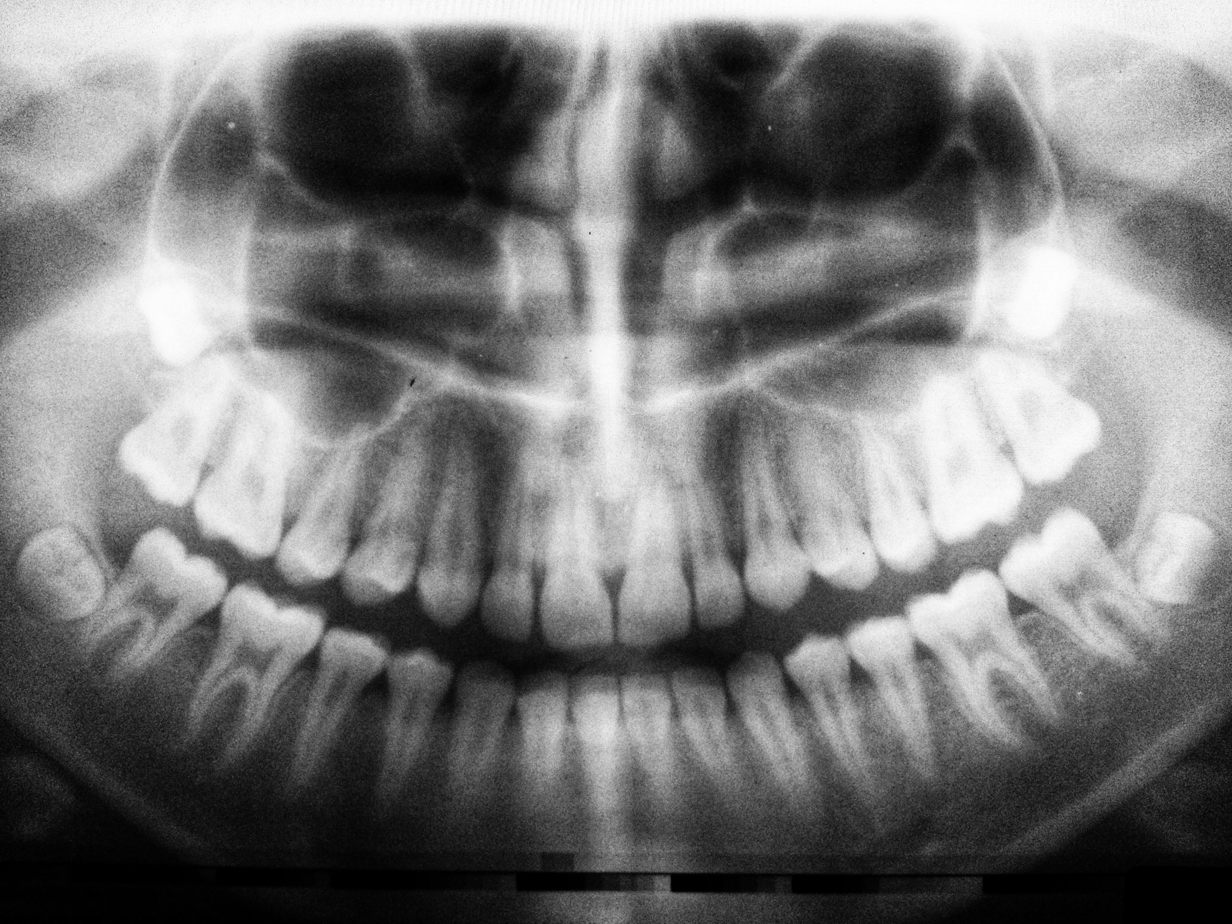 Root Canal Treatment